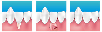 Dentiste Montrouge 92 parodontopathie