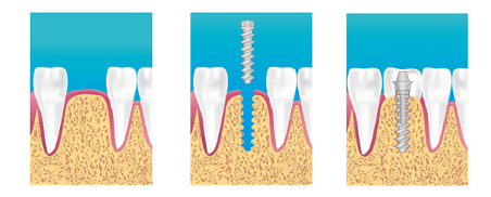 Montrouge dentiste Implant dentaire